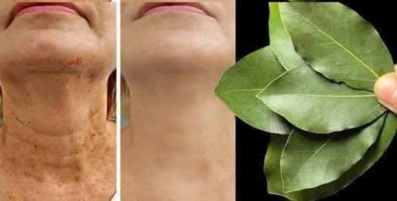 Bay Leaf: 100,000 Times Stronger Than Botox?